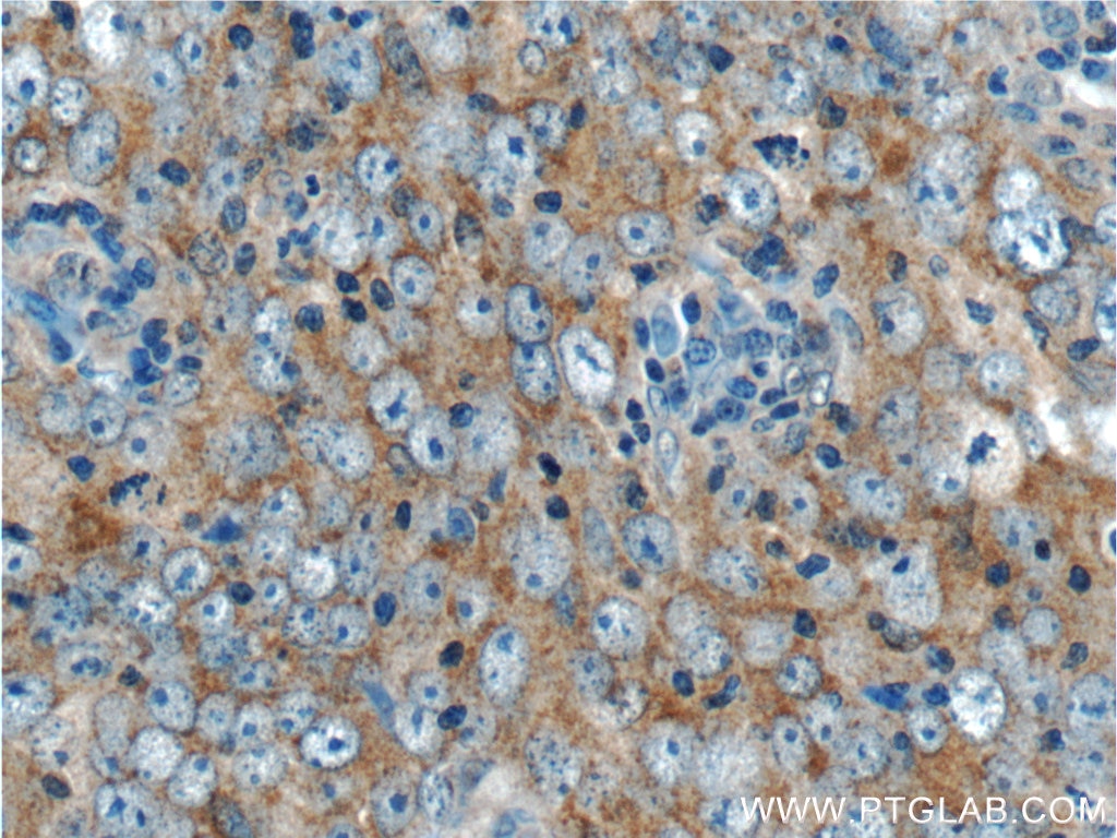 Immunohistochemistry (IHC) staining of human breast cancer tissue using LC3 Polyclonal antibody (14600-1-AP)