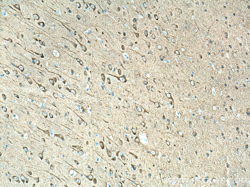 Immunohistochemistry (IHC) staining of human gliomas tissue using LC3 Polyclonal antibody (14600-1-AP)