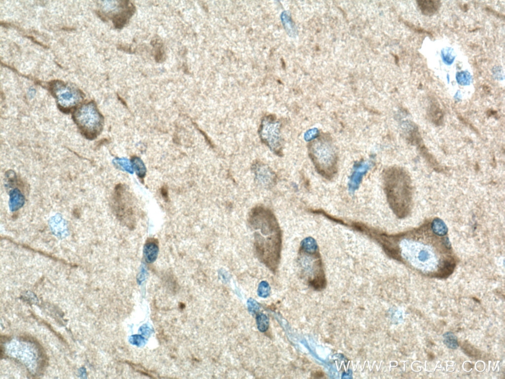 Immunohistochemistry (IHC) staining of human gliomas tissue using LC3 Polyclonal antibody (14600-1-AP)