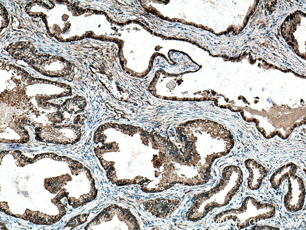 Immunohistochemistry (IHC) staining of human prostate cancer tissue using MAP1S Polyclonal antibody (15695-1-AP)