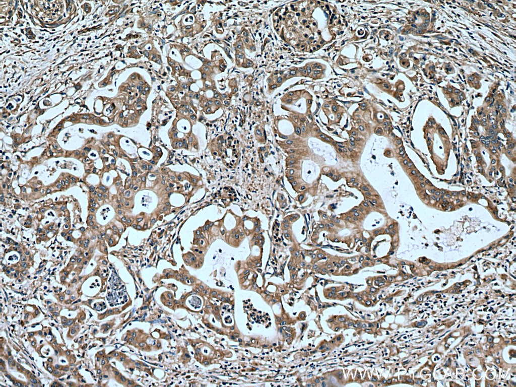 Immunohistochemistry (IHC) staining of human pancreas cancer tissue using MAP1S Polyclonal antibody (15695-1-AP)