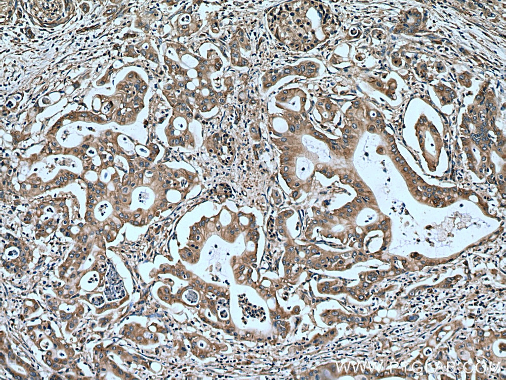 IHC staining of human pancreas cancer using 15695-1-AP