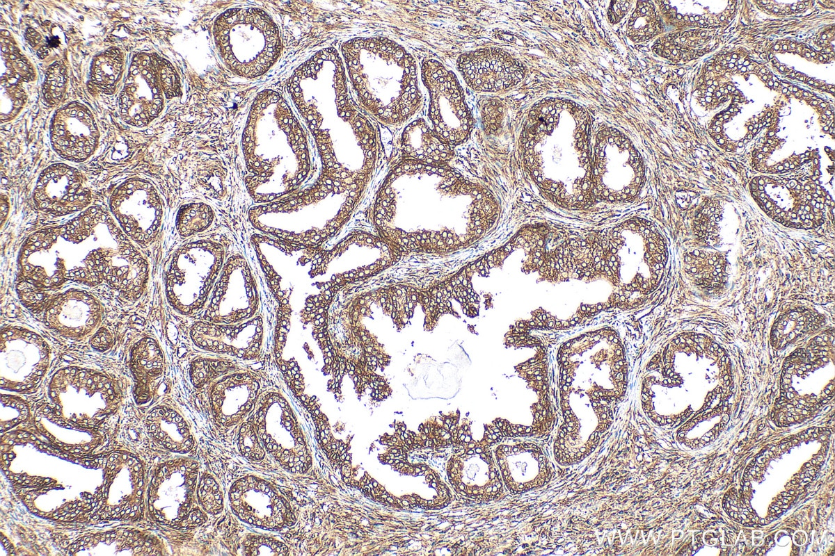 Immunohistochemistry (IHC) staining of human prostate cancer tissue using MAP1S Polyclonal antibody (15695-1-AP)