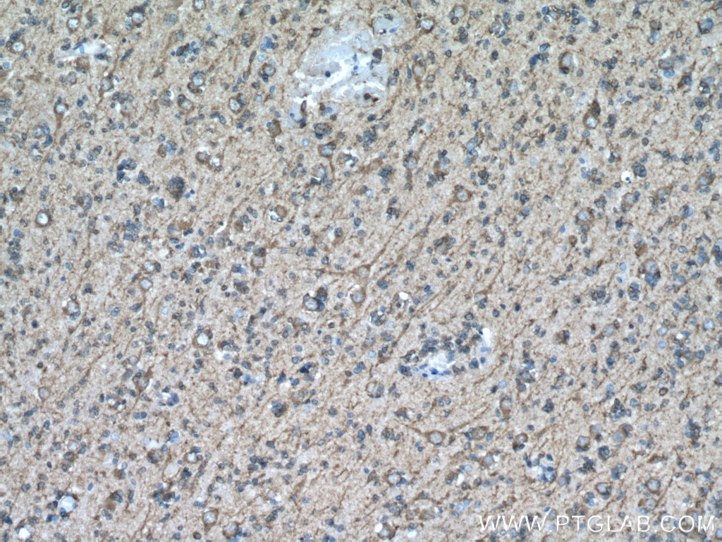 IHC staining of human gliomas using 17490-1-AP