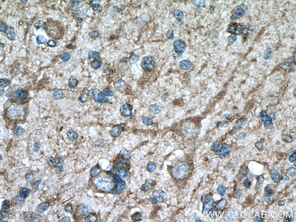 Immunohistochemistry (IHC) staining of human gliomas tissue using MAP2 Polyclonal antibody (17490-1-AP)