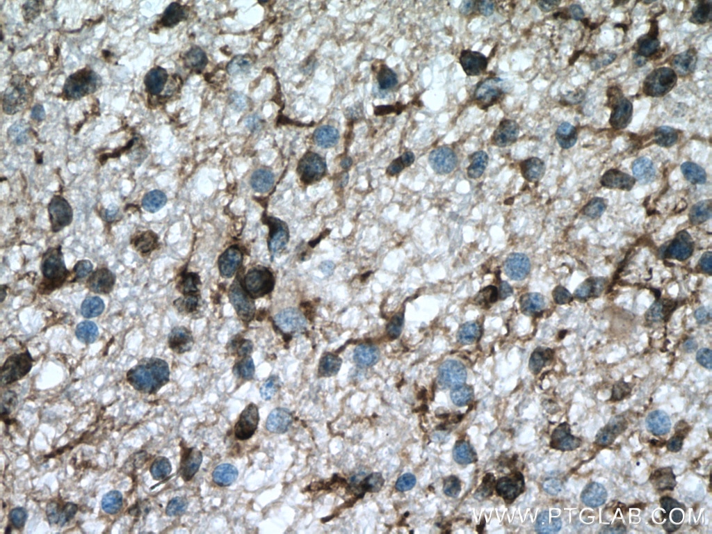 IHC staining of human gliomas using 17490-1-AP