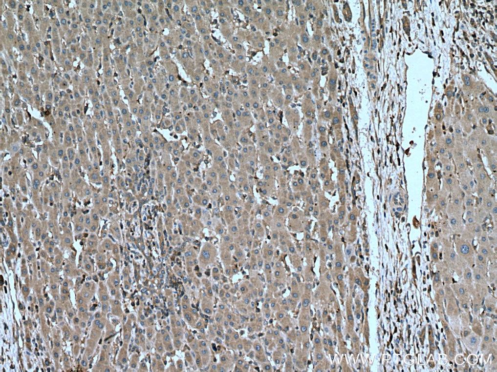 Immunohistochemistry (IHC) staining of human liver cancer tissue using MEK2 Monoclonal antibody (67410-1-Ig)