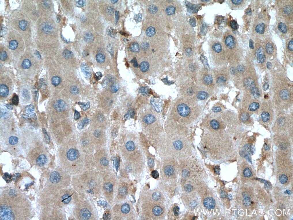 Immunohistochemistry (IHC) staining of human liver cancer tissue using MEK2 Monoclonal antibody (67410-1-Ig)