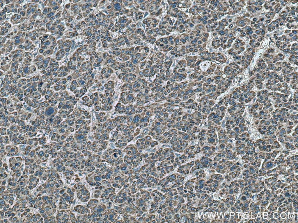 Immunohistochemistry (IHC) staining of human liver cancer tissue using MAP2K4 Polyclonal antibody (17340-1-AP)