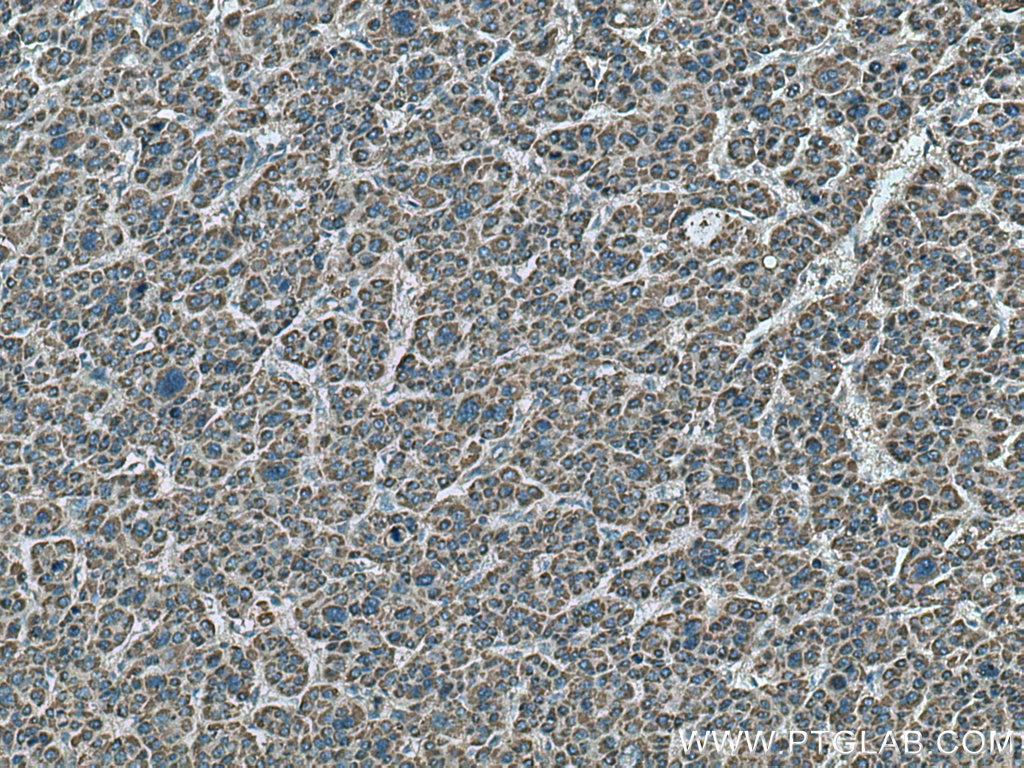 IHC staining of human liver cancer using 17340-1-AP