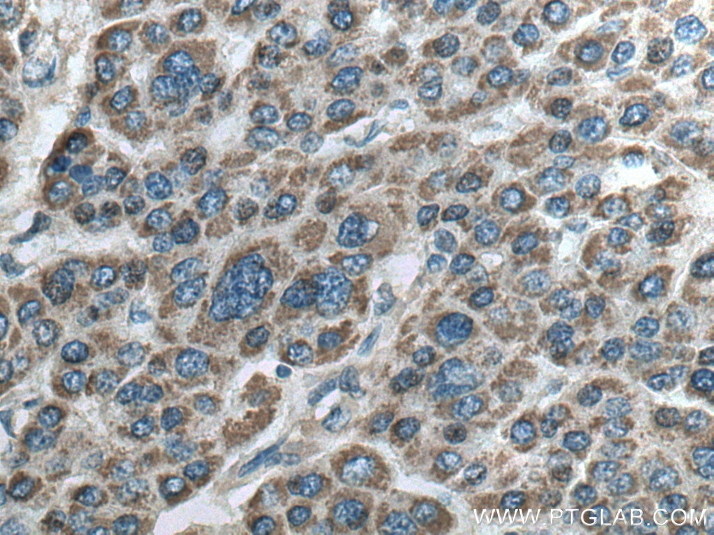 IHC staining of human liver cancer using 17340-1-AP