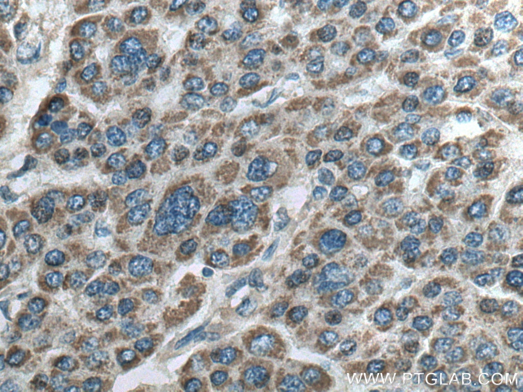 Immunohistochemistry (IHC) staining of human liver cancer tissue using MAP2K4 Polyclonal antibody (17340-1-AP)