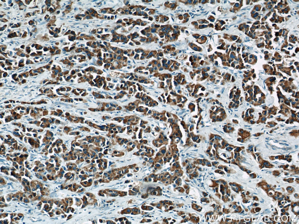 Immunohistochemistry (IHC) staining of human breast cancer tissue using MAP2K4 Polyclonal antibody (17340-1-AP)