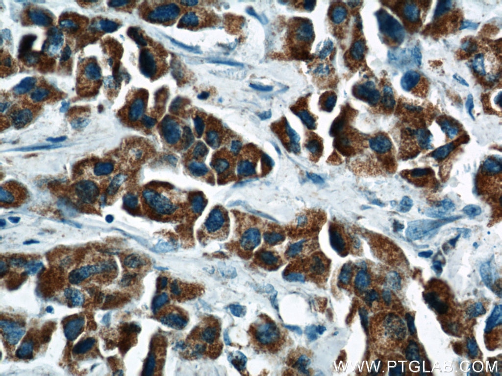 Immunohistochemistry (IHC) staining of human breast cancer tissue using MAP2K4 Polyclonal antibody (17340-1-AP)