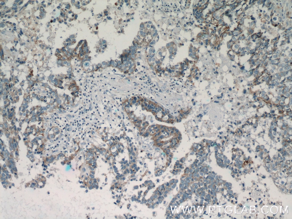 Immunohistochemistry (IHC) staining of human breast cancer tissue using MAP2K4 Polyclonal antibody (51142-1-AP)