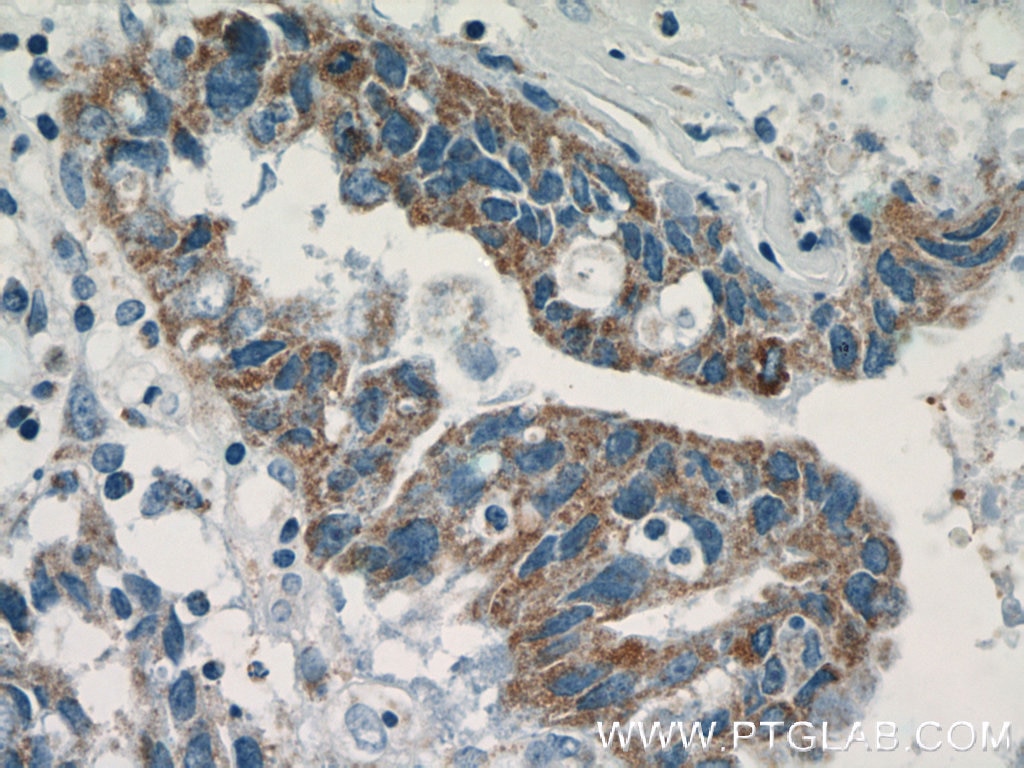 Immunohistochemistry (IHC) staining of human breast cancer tissue using MAP2K4 Polyclonal antibody (51142-1-AP)