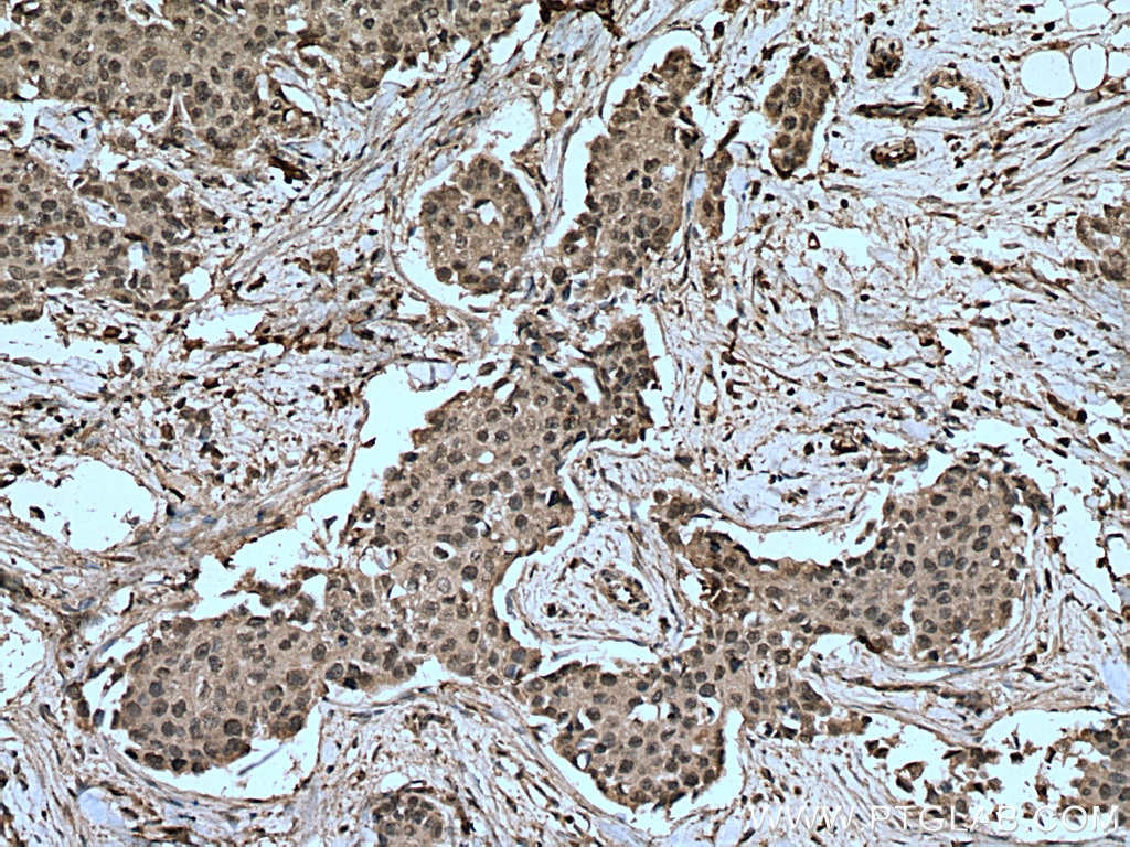 Immunohistochemistry (IHC) staining of human breast cancer tissue using MAP2K4 Monoclonal antibody (67333-1-Ig)
