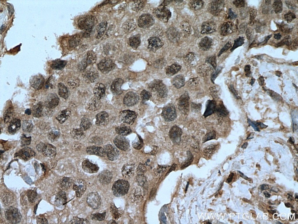 Immunohistochemistry (IHC) staining of human breast cancer tissue using MAP2K4 Monoclonal antibody (67333-1-Ig)