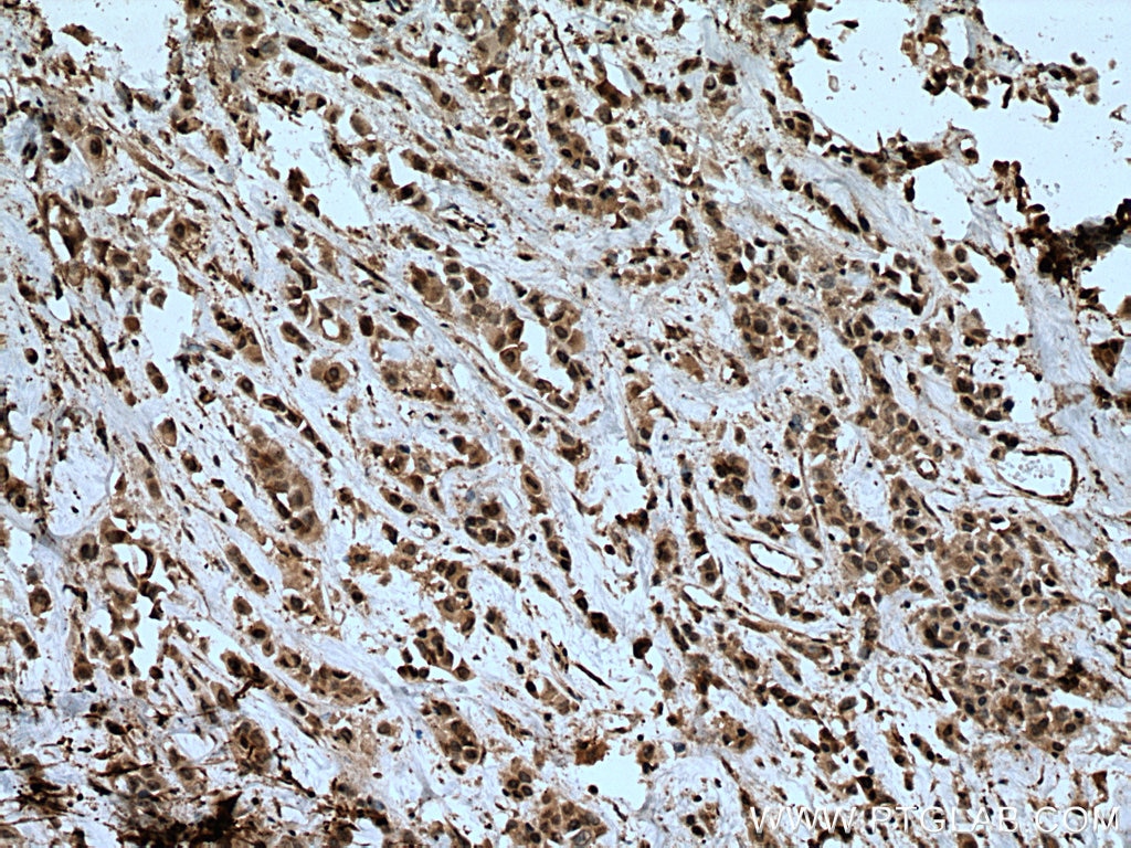 Immunohistochemistry (IHC) staining of human breast cancer tissue using MEK6 Polyclonal antibody (12745-1-AP)