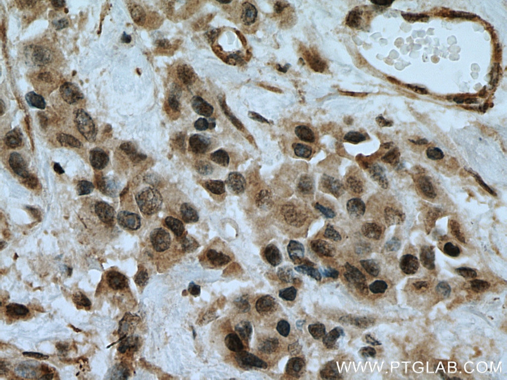 Immunohistochemistry (IHC) staining of human breast cancer tissue using MEK6 Polyclonal antibody (12745-1-AP)