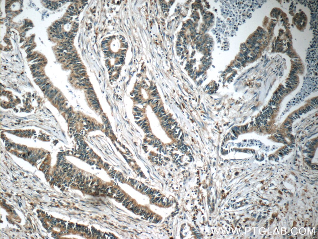 Immunohistochemistry (IHC) staining of human pancreas cancer tissue using MLK2 Polyclonal antibody (19974-1-AP)