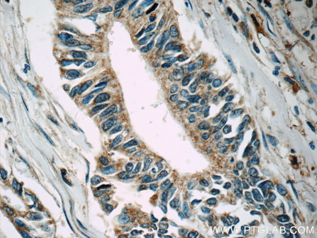 Immunohistochemistry (IHC) staining of human pancreas cancer tissue using MLK2 Polyclonal antibody (19974-1-AP)