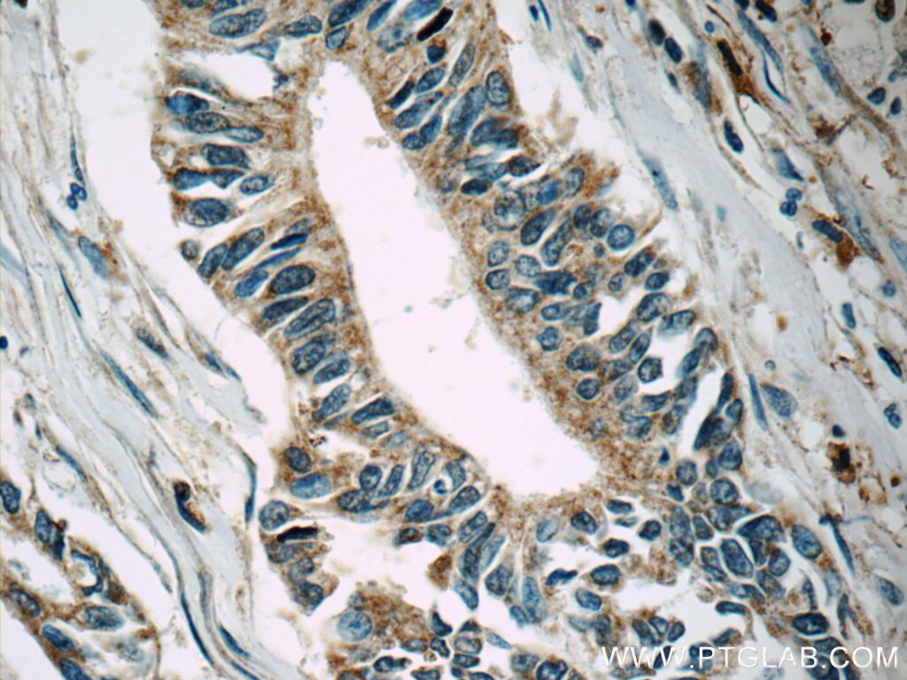 Immunohistochemistry (IHC) staining of human pancreas cancer tissue using MLK2 Polyclonal antibody (19974-1-AP)
