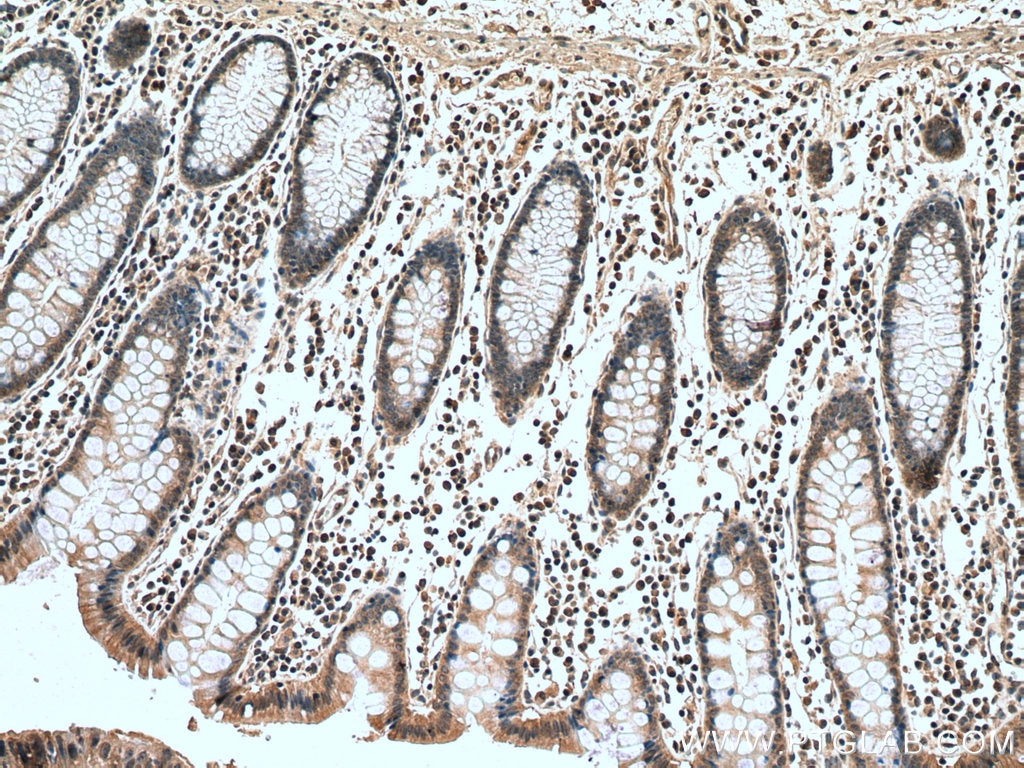 Immunohistochemistry (IHC) staining of human colon cancer tissue using MLK3 Polyclonal antibody (11996-1-AP)