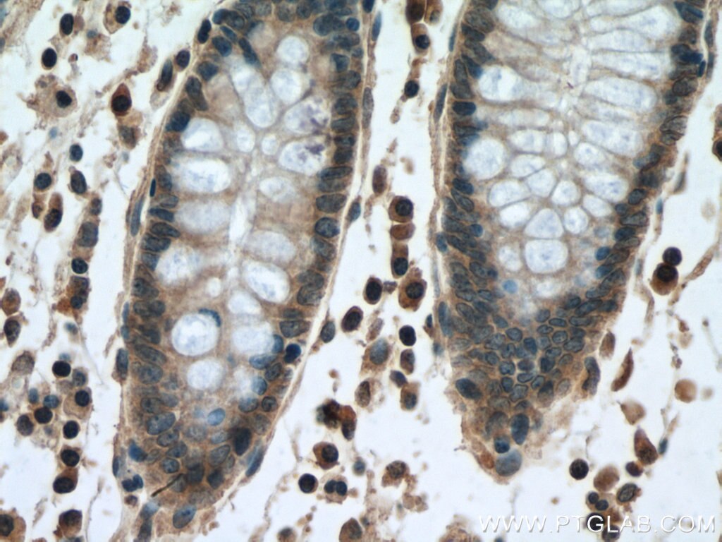 Immunohistochemistry (IHC) staining of human colon cancer tissue using MLK3 Polyclonal antibody (11996-1-AP)