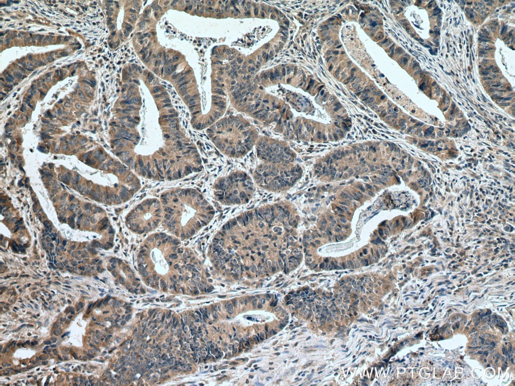 Immunohistochemistry (IHC) staining of human colon cancer tissue using MLK3 Polyclonal antibody (11996-1-AP)