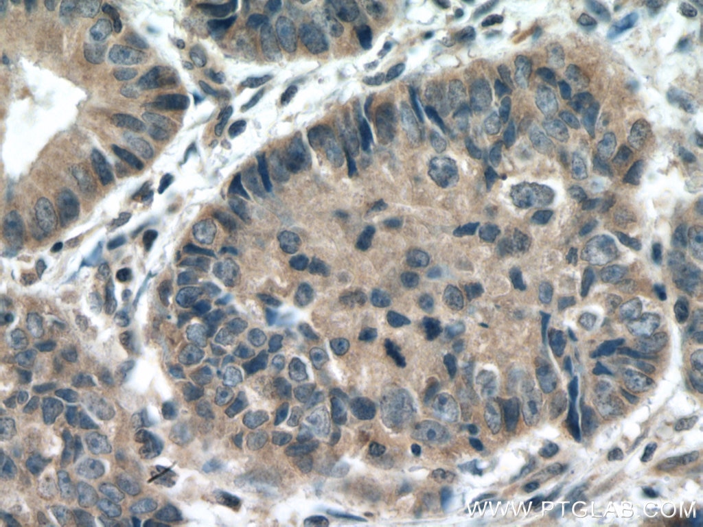 IHC staining of human colon cancer using 11996-1-AP