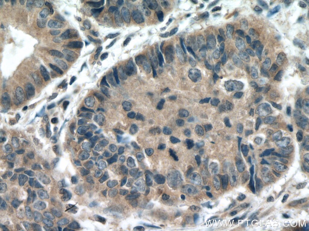 Immunohistochemistry (IHC) staining of human colon cancer tissue using MLK3 Polyclonal antibody (11996-1-AP)