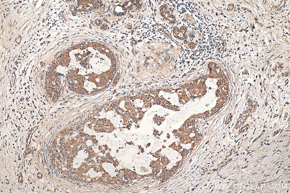 IHC staining of human breast cancer using 29265-1-AP Immunohistochemistry (IHC) staining of human breast cancer tissue using MEKK2 Polyclonal antibody (29265-1-AP)