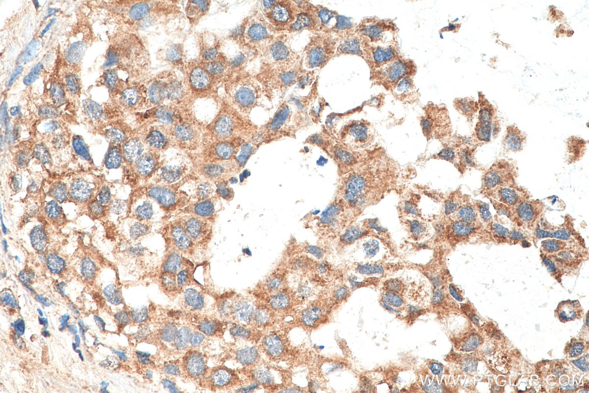 Immunohistochemistry (IHC) staining of human breast cancer tissue using MEKK2 Polyclonal antibody (29265-1-AP)