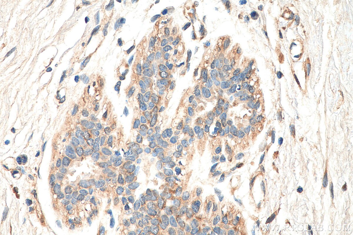 Immunohistochemistry (IHC) staining of human breast cancer tissue using MEKK2 Polyclonal antibody (29265-1-AP)