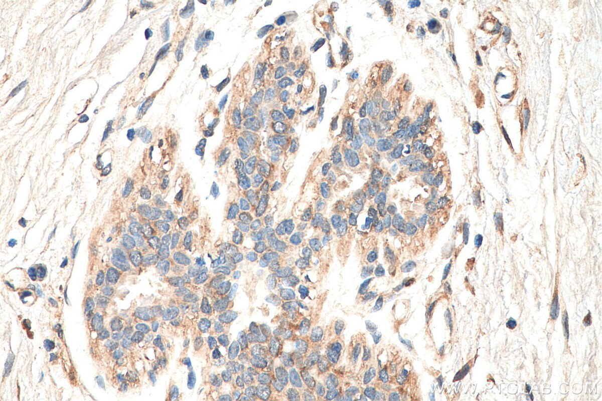 Immunohistochemistry (IHC) staining of human breast cancer tissue using MAP3K2 Polyclonal antibody (29265-1-AP)