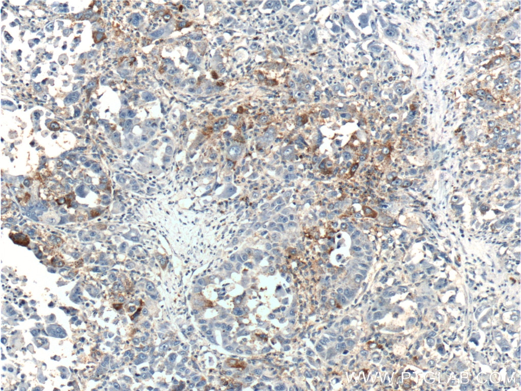 Immunohistochemistry (IHC) staining of human liver cancer tissue using MAP3K6 Polyclonal antibody (16212-1-AP)