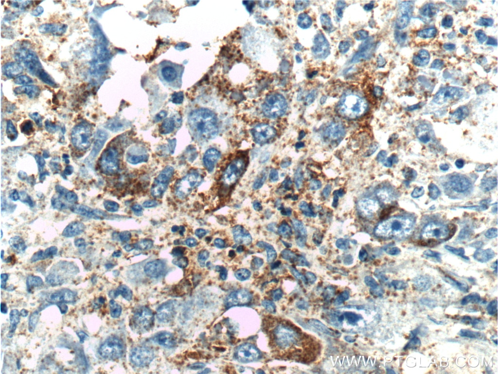 Immunohistochemistry (IHC) staining of human liver cancer tissue using MAP3K6 Polyclonal antibody (16212-1-AP)