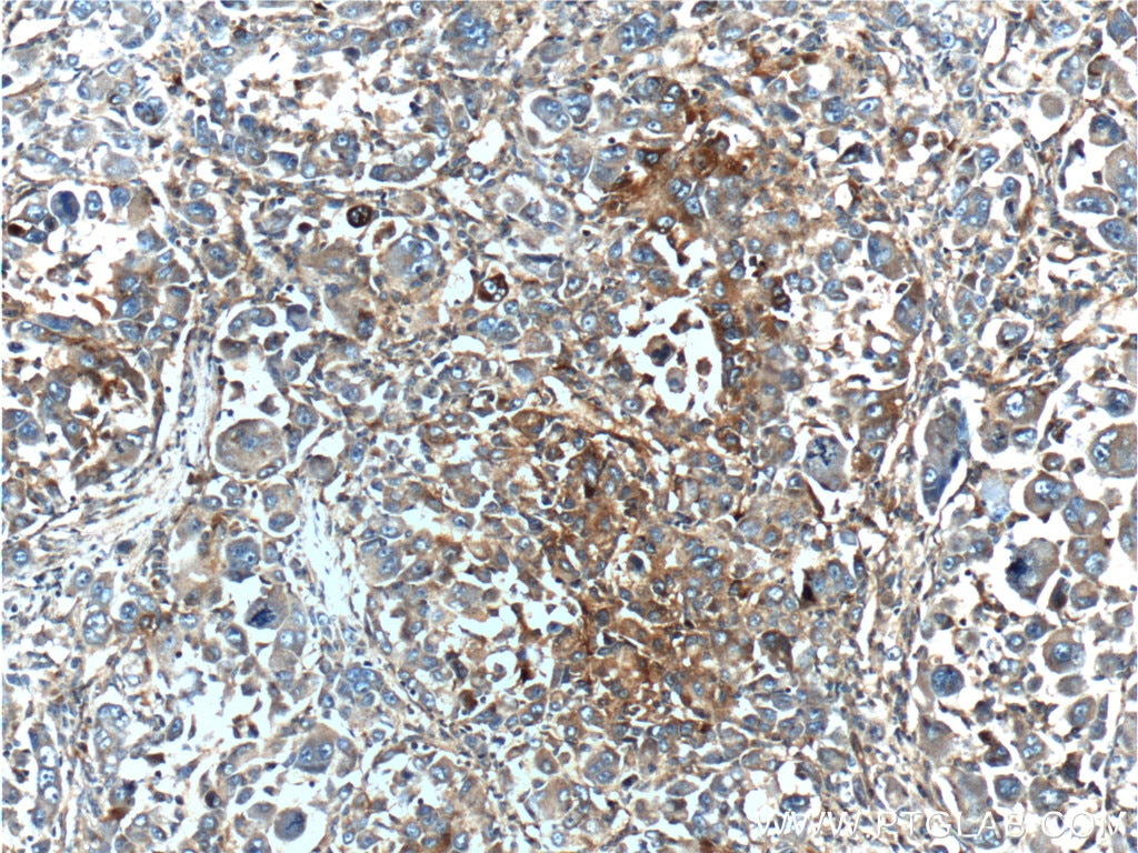 Immunohistochemistry (IHC) staining of human liver cancer tissue using MAP3K6 Polyclonal antibody (16212-1-AP)