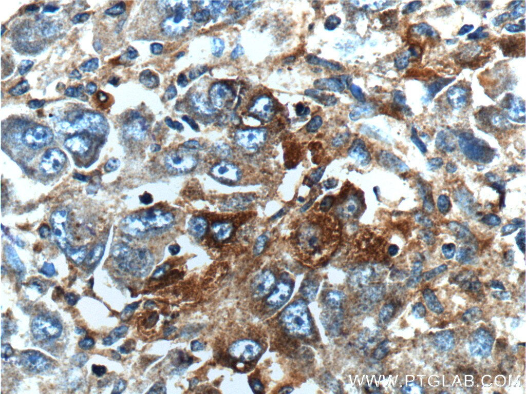 Immunohistochemistry (IHC) staining of human liver cancer tissue using MAP3K6 Polyclonal antibody (16212-1-AP)