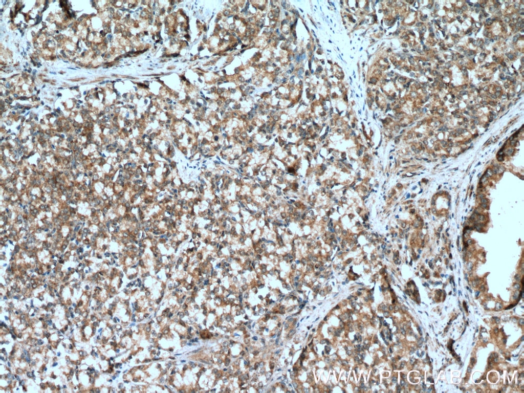 IHC staining of human prostate cancer using 12330-2-AP