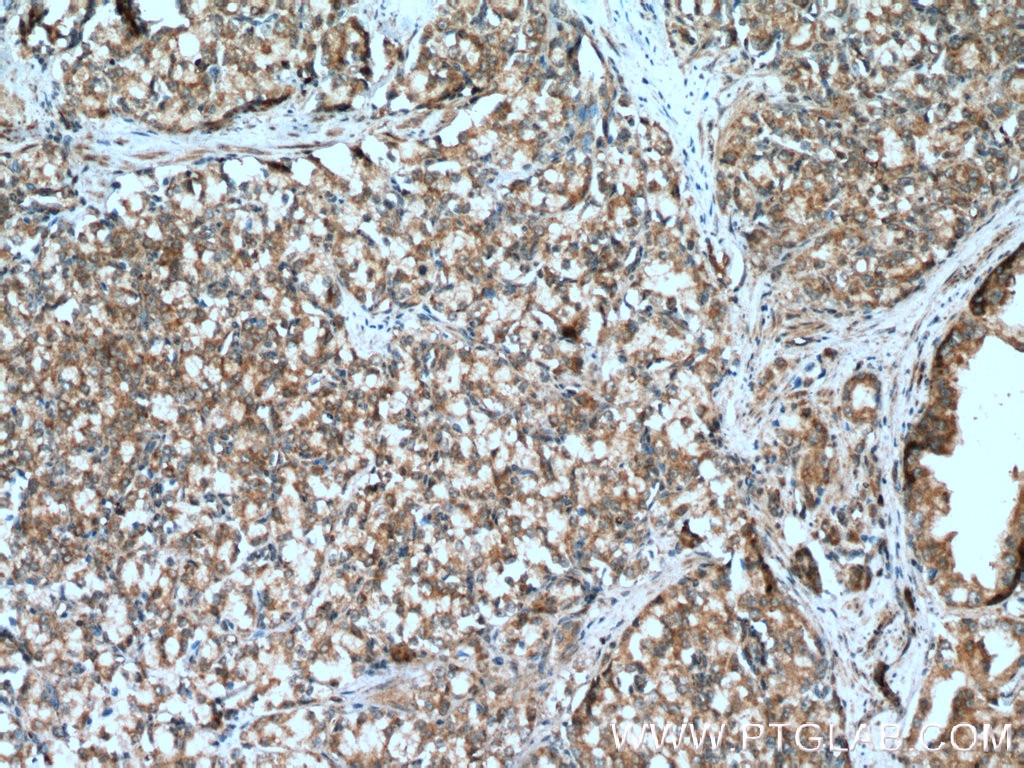 Immunohistochemistry (IHC) staining of human prostate cancer tissue using TAK1 Polyclonal antibody (12330-2-AP)