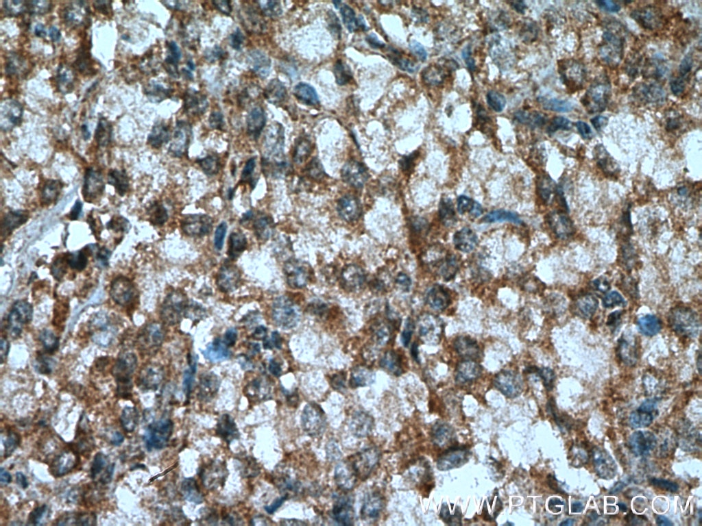 Immunohistochemistry (IHC) staining of human prostate cancer tissue using TAK1 Polyclonal antibody (12330-2-AP)