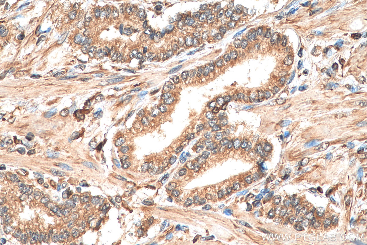 IHC staining of human prostate cancer using 29167-1-AP