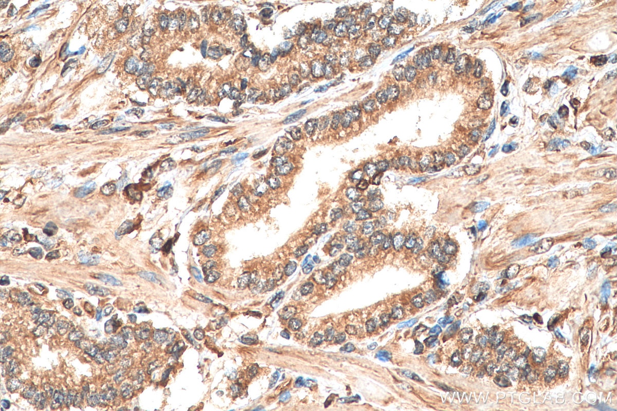 Immunohistochemistry (IHC) staining of human prostate cancer tissue using TAK1 Polyclonal antibody (29167-1-AP)