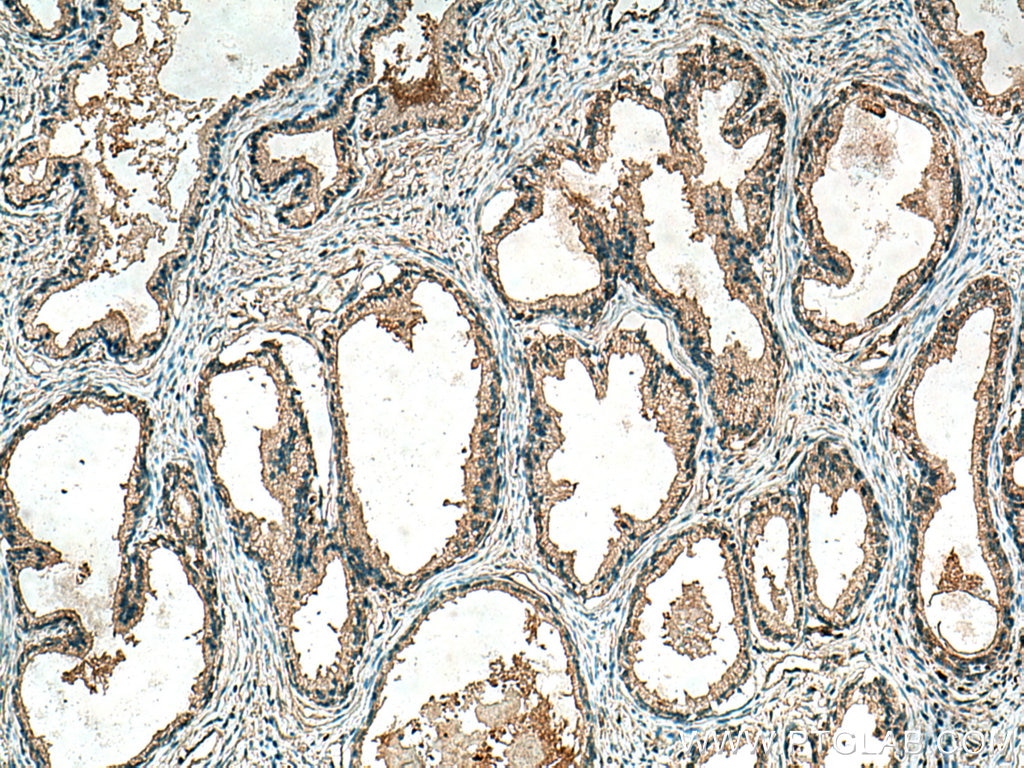 IHC staining of human prostate cancer using 67707-1-Ig