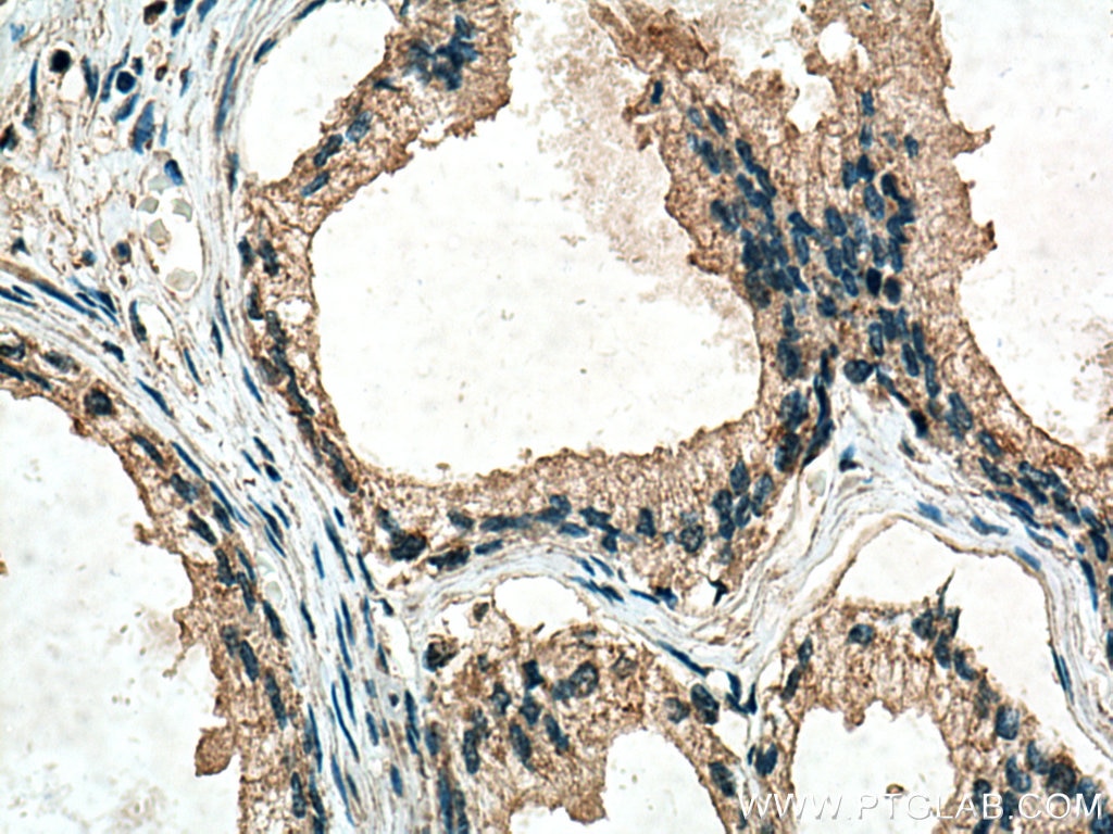 Immunohistochemistry (IHC) staining of human prostate cancer tissue using TAK1 Monoclonal antibody (67707-1-Ig)