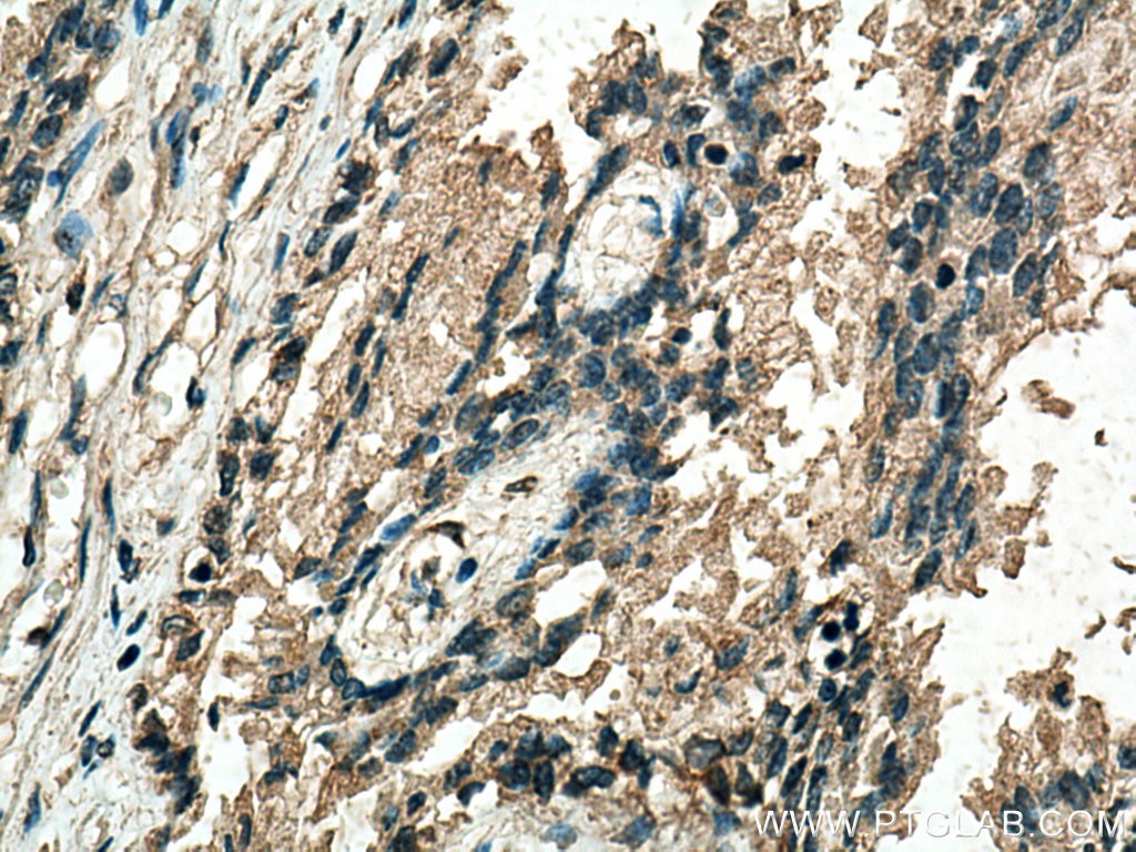 IHC staining of human prostate cancer using 67707-1-Ig