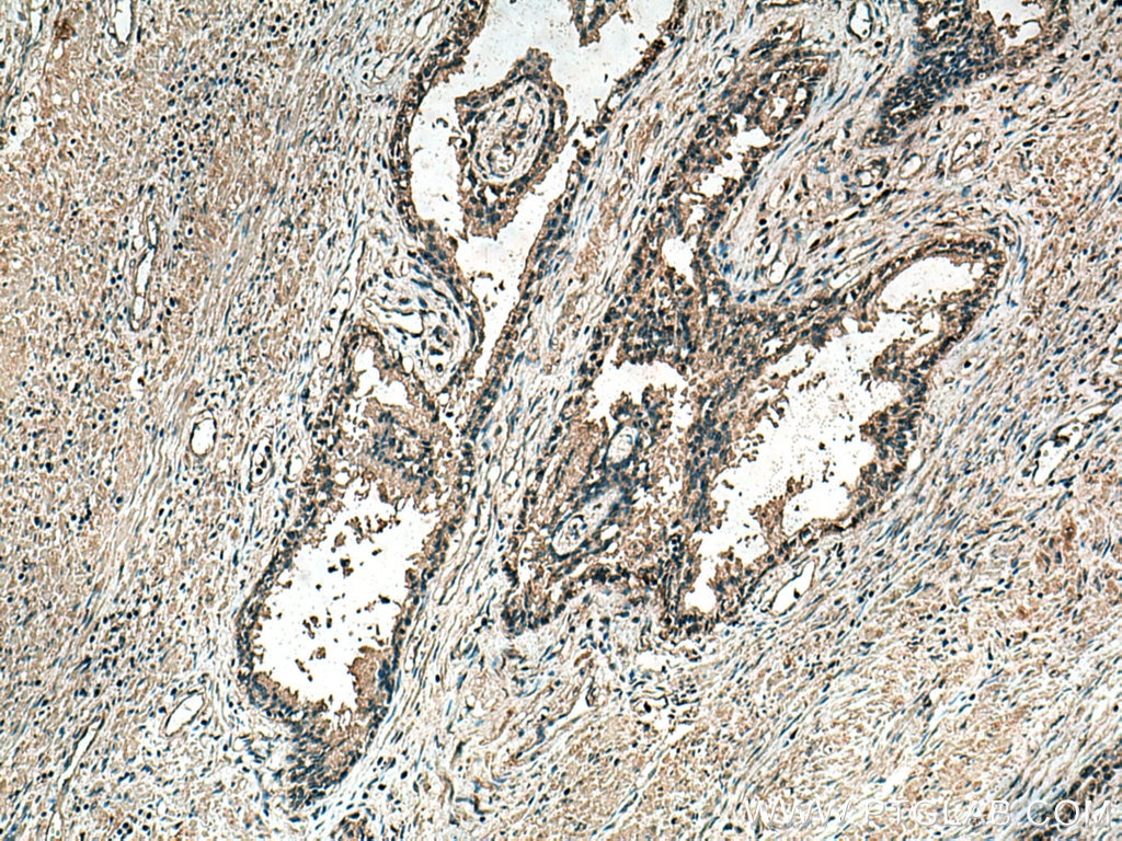 Immunohistochemistry (IHC) staining of human prostate cancer tissue using TAK1 Monoclonal antibody (67707-1-Ig)