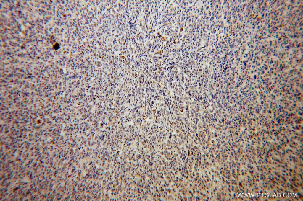 IHC staining of human malignant melanoma using 14410-1-AP